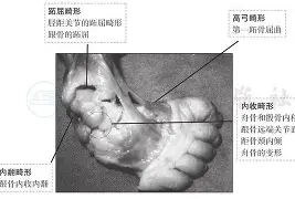 跗骨之蛆有多恶心？对手打越狠反伤越疼的机制
